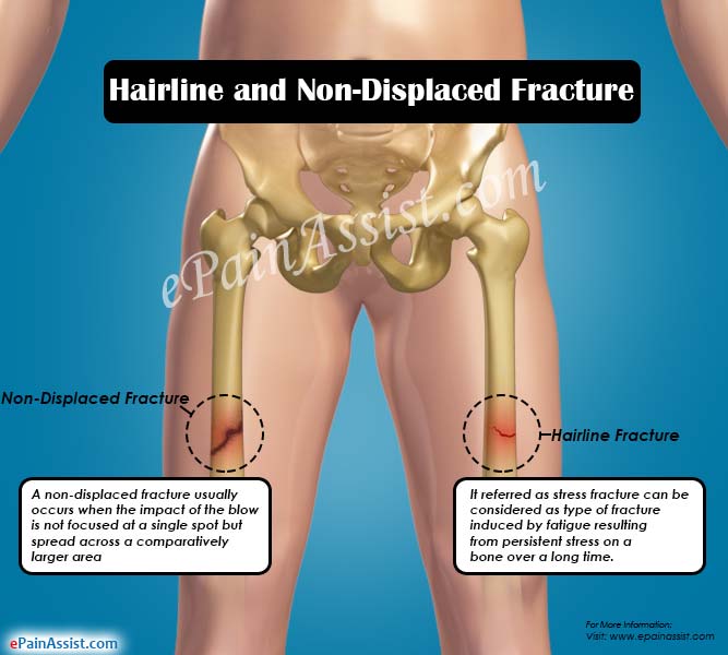 Hairline Crack In The Bone Stress Fracture
